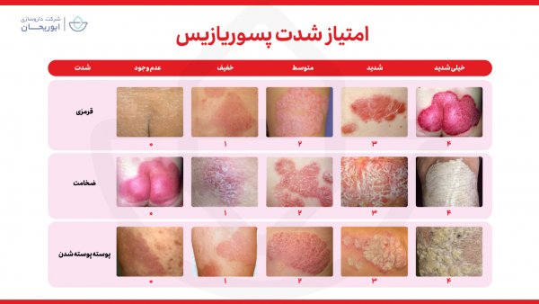  درمان خانگی پسوریازیس تناسلی + علت ، علائم + عوارض