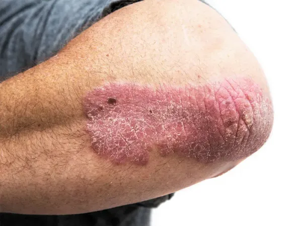  پسوریازیس چرا بوجود میاد + انواع پسوریازیس + بهترین درمان پسوریازیس