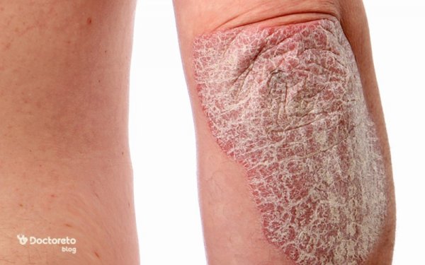  پسوریازیس چرا بوجود میاد + انواع پسوریازیس + بهترین درمان پسوریازیس