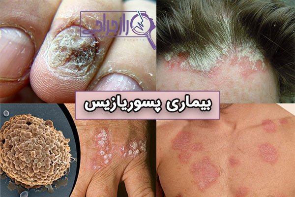  پسوریازیس چرا بوجود میاد + انواع پسوریازیس + بهترین درمان پسوریازیس