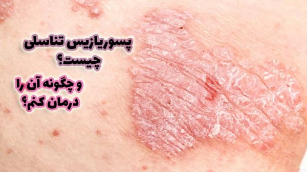 پسوریازیس چگونه منتقل میشود؟