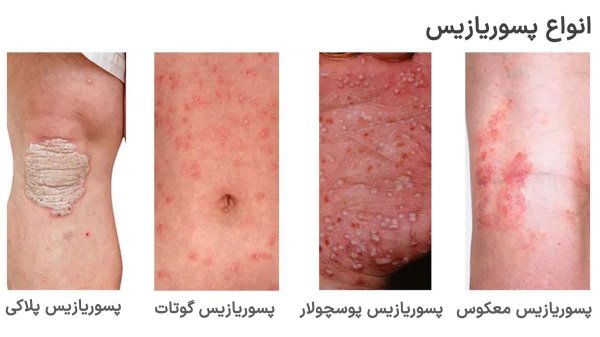  پسوریازیس چگونه منتقل میشود؟