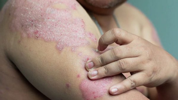 آیا پسوریازیس باعث چاق شدن میشود؟