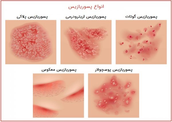  آیا پسوریازیس باعث چاق شدن میشود؟