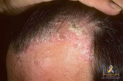  آیا پسوریازیس باعث چاق شدن میشود؟