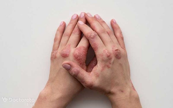 عکس بیماری پسوریازیس دست + علت و علائم + درمان