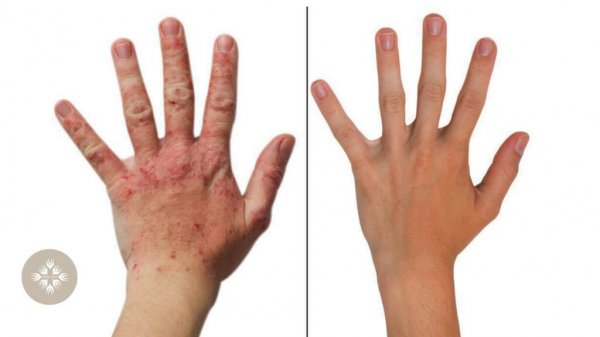 عکس بیماری پسوریازیس دست + علت و علائم + درمان