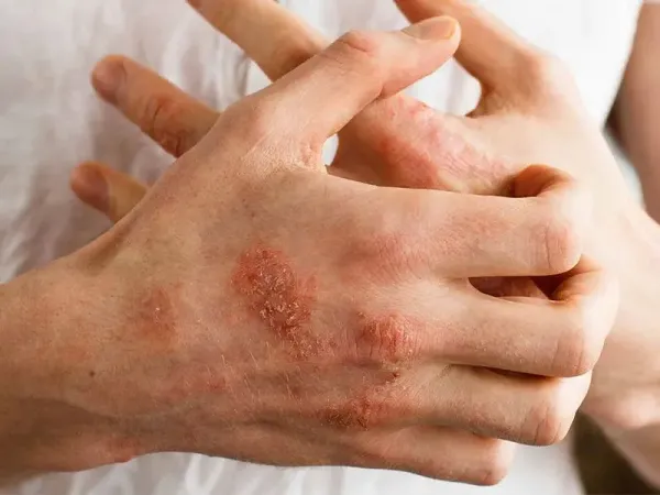  جینسینگ و پسوریازیس