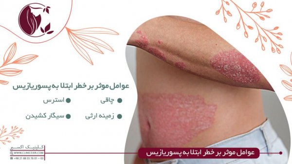  جینسینگ و پسوریازیس