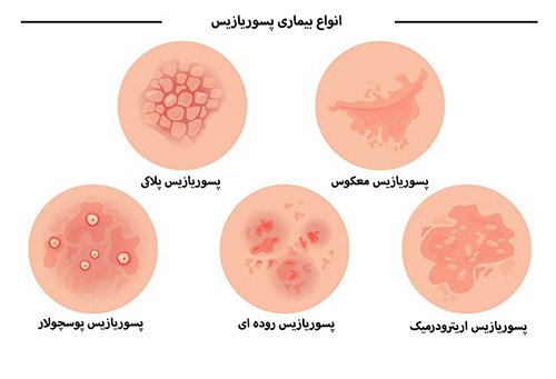  آمپول برای درمان پسوریازیس