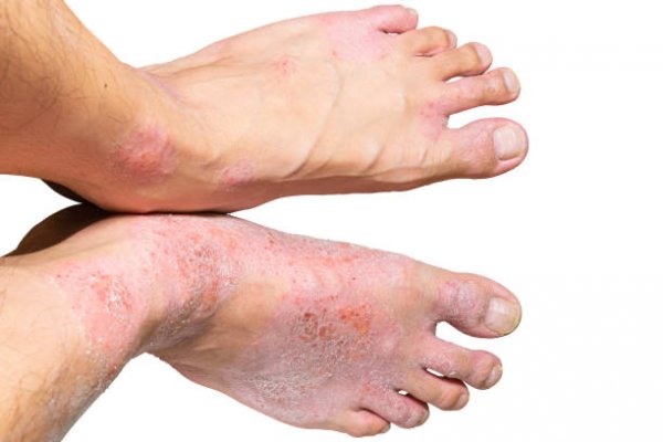  جوراب مخصوص پسوریازیس + عکس بیماری پسوریازیس پا