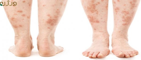  جوراب مخصوص پسوریازیس + عکس بیماری پسوریازیس پا