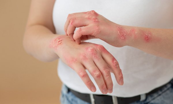 چه چیزهایی برای بیماری پسوریازیس مضر است؟