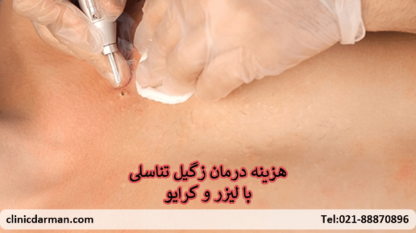 هزینه کرایو زگیل تناسلی