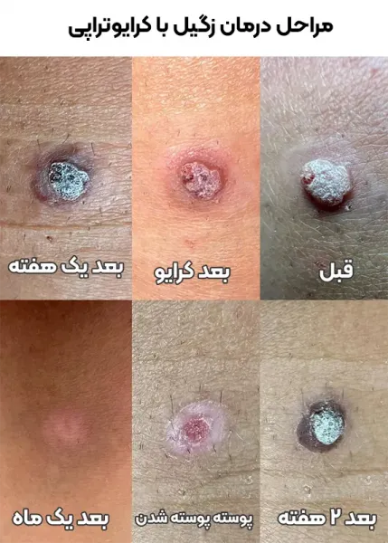  هزینه کرایو زگیل تناسلی