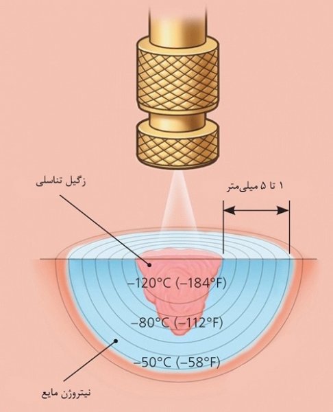  هزینه کرایو زگیل تناسلی