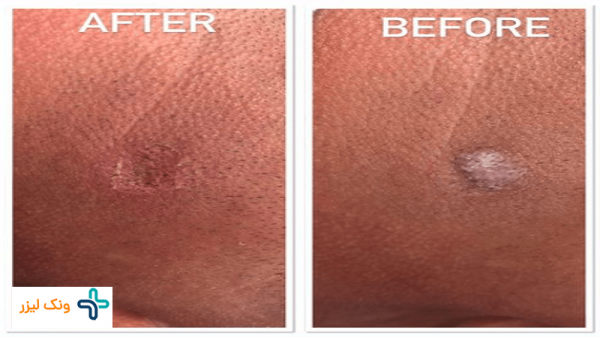  هزینه کرایو زگیل تناسلی