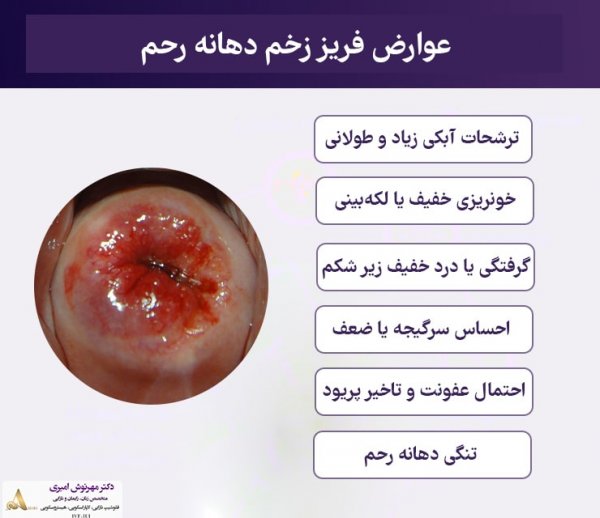  مراقبت های بعد از فریز زخم دهانه رحم