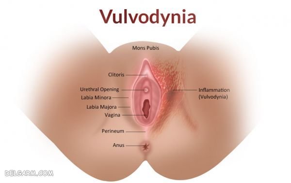  مراقبت های بعد از فریز زخم دهانه رحم