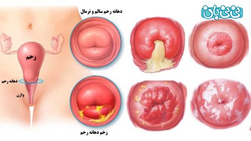  مراقبت های بعد از فریز زخم دهانه رحم
