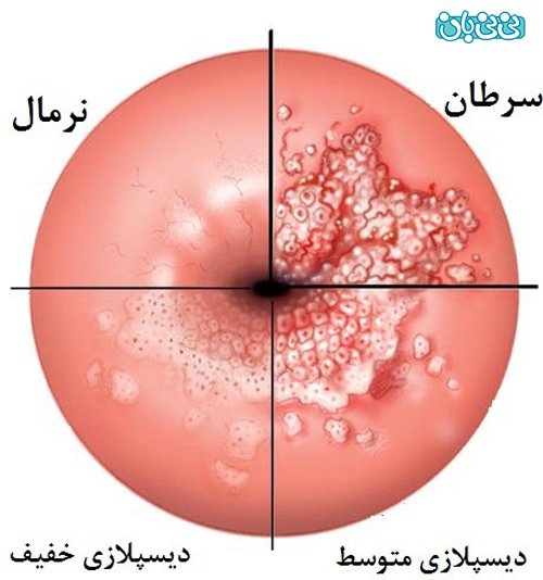  مراقبت های بعد از فریز زخم دهانه رحم