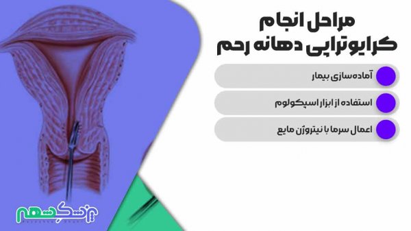  مراقبت های بعد از فریز زخم دهانه رحم