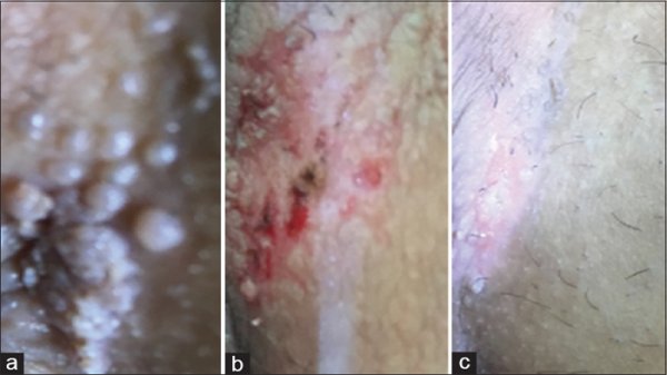  سوزاندن زگیل تناسلی در مردان + سوزاندن زگیل تناسلی با هویه