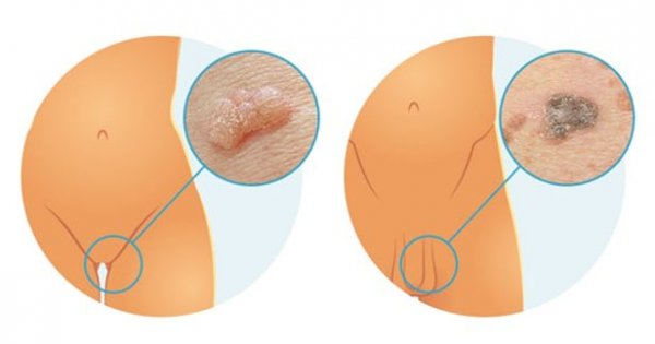  سوزاندن زگیل تناسلی در مردان + سوزاندن زگیل تناسلی با هویه