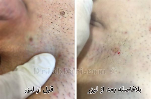  سوزاندن زگیل تناسلی در مردان + سوزاندن زگیل تناسلی با هویه