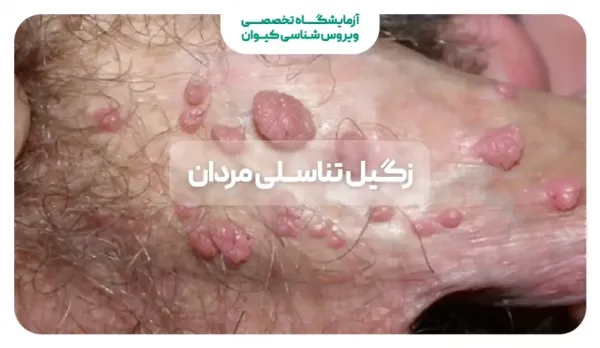  سوزاندن زگیل تناسلی در مردان + سوزاندن زگیل تناسلی با هویه
