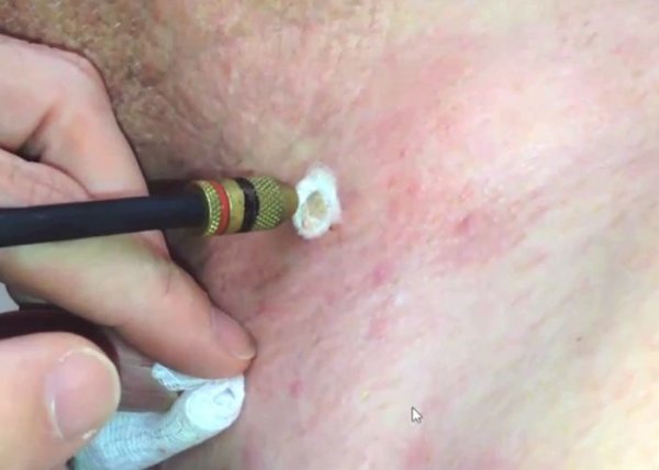  سوزاندن زگیل تناسلی در مردان + سوزاندن زگیل تناسلی با هویه