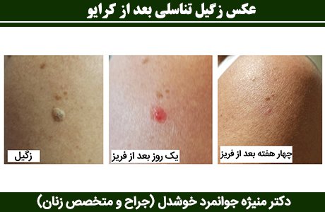  فرق کرایو با فریز