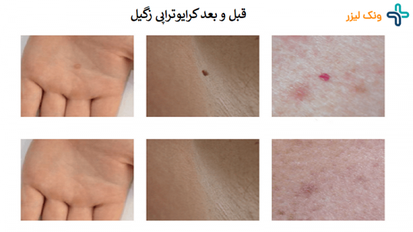  فرق کرایو با فریز