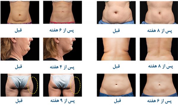  کرایولیپولیز برای چه افرادی مناسب است؟