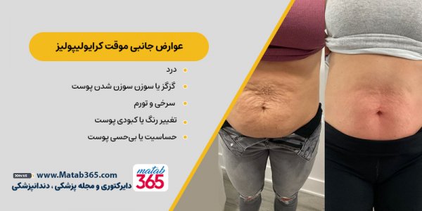  کرایولیپولیز برای چه افرادی مناسب است؟