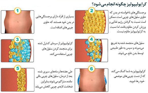  کرایولیپولیز برای چه افرادی مناسب است؟