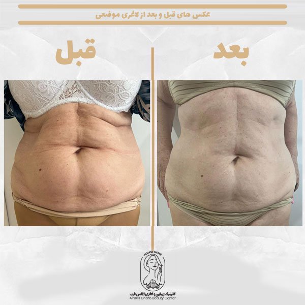  کرایولیپولیز برای چه افرادی مناسب است؟