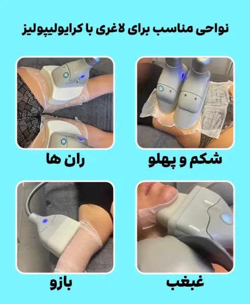  کرایولیپولیز برای چه افرادی مناسب است؟