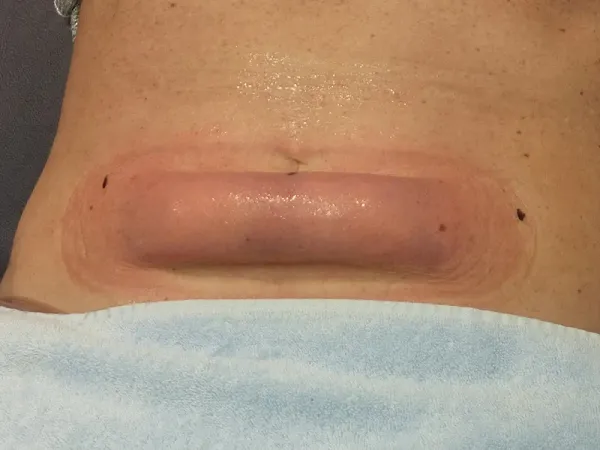  کرایولیپولیز برای چه افرادی مناسب است؟