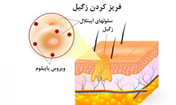  نحوه کرایو زگیل تناسلی