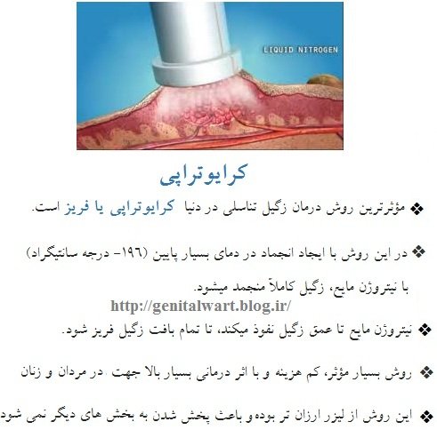  نحوه کرایو زگیل تناسلی