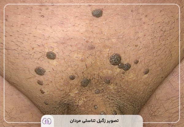  نحوه کرایو زگیل تناسلی