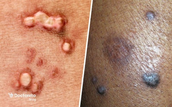  نحوه کرایو زگیل تناسلی