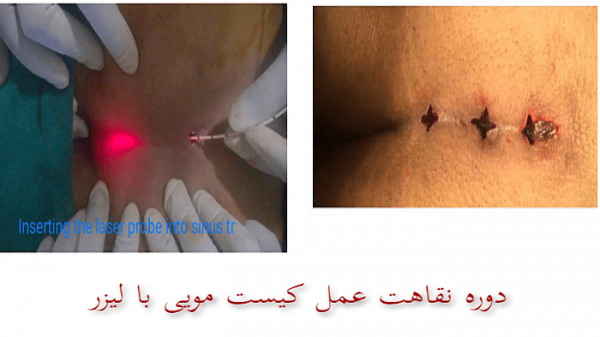 دوران نقاهت بعد از عمل کیست مویی با لیزر + فیلم و عکس واقعی