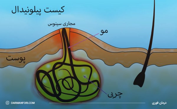  دوران نقاهت بعد از عمل کیست مویی با لیزر + فیلم و عکس واقعی