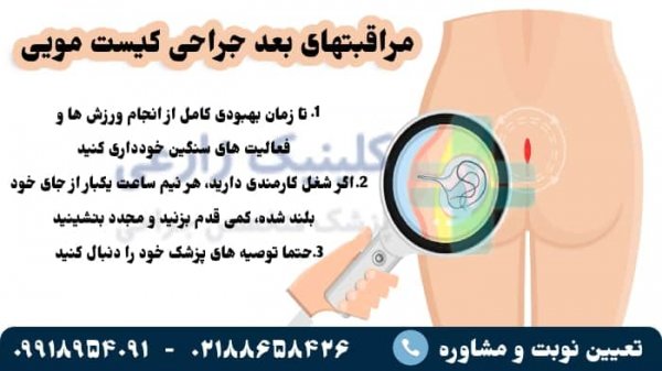  دوران نقاهت بعد از عمل کیست مویی با لیزر + فیلم و عکس واقعی