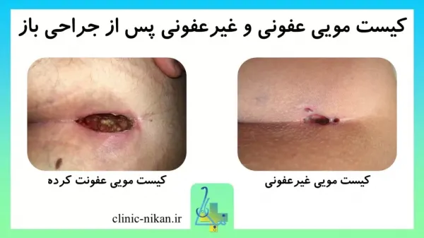  دوران نقاهت بعد از عمل کیست مویی با لیزر + فیلم و عکس واقعی