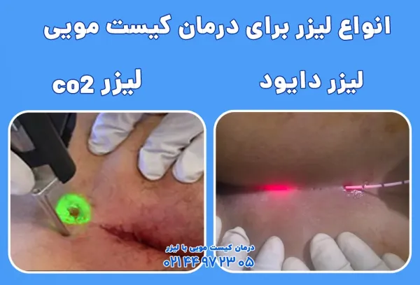  دوران نقاهت بعد از عمل کیست مویی با لیزر + فیلم و عکس واقعی