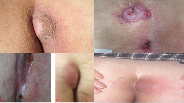  عکس عفونت کیست مویی بعد از عمل