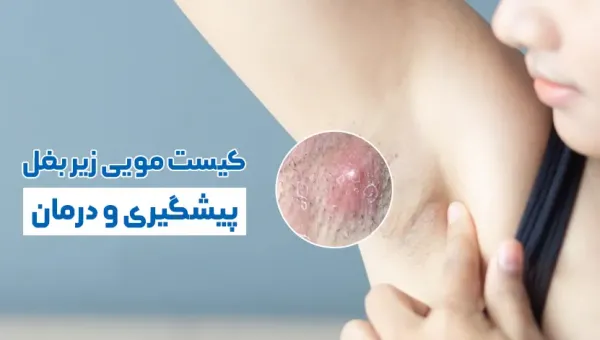 کیست زیر بغل چه علائمی دارد؟